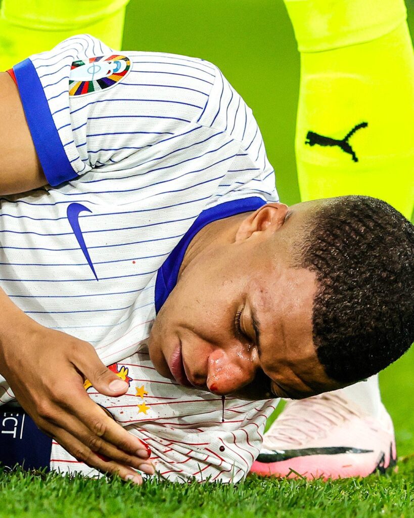 Kylian Mbappé fracture du nez Euro 2024